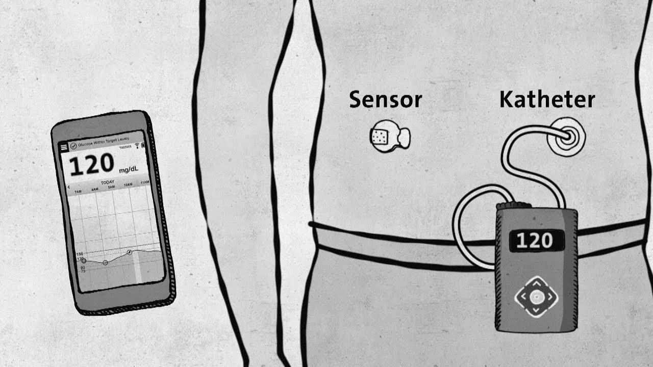 Kind 1 diabetes – trendy know-how without approval – good to know